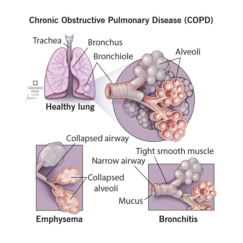 Nursing care plan for chronic obstructive pulmonary disease